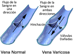 Várices